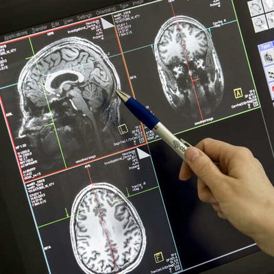 MRT Bild eines menschlichen Gehirns